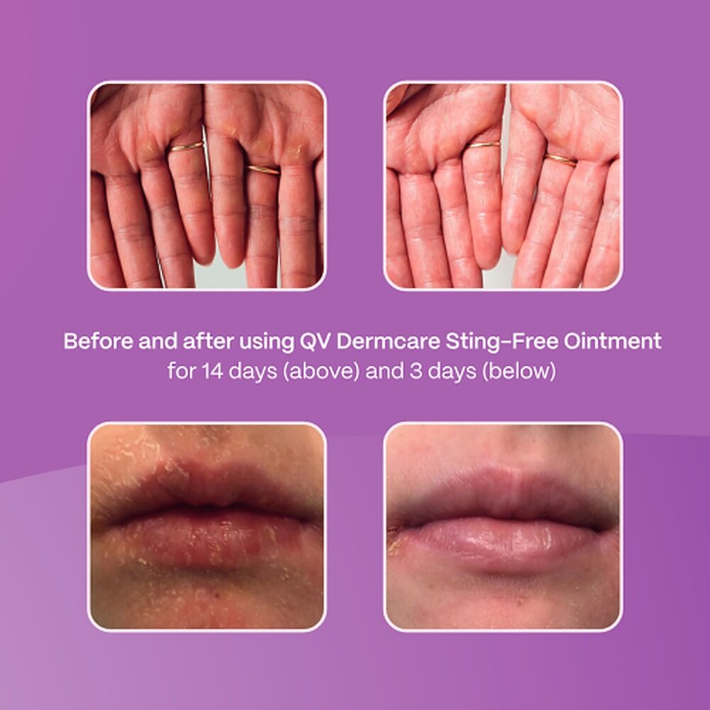 Ego Dermatological Sting-Free Soothing Ointment 100g